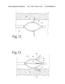 Method to treat gastric reflux via the detection and ablation of gastro-esophageal nerves and receptors diagram and image