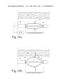 Method to treat gastric reflux via the detection and ablation of gastro-esophageal nerves and receptors diagram and image