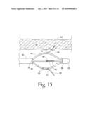 Method to treat gastric reflux via the detection and ablation of gastro-esophageal nerves and receptors diagram and image