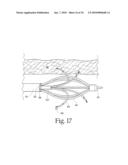 Method to treat gastric reflux via the detection and ablation of gastro-esophageal nerves and receptors diagram and image