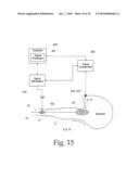 Method to treat gastric reflux via the detection and ablation of gastro-esophageal nerves and receptors diagram and image