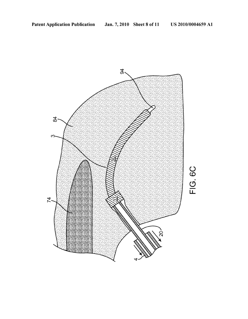 Cavitation Depth, Perforation Confirmation and Implant Delivery Tool - diagram, schematic, and image 09