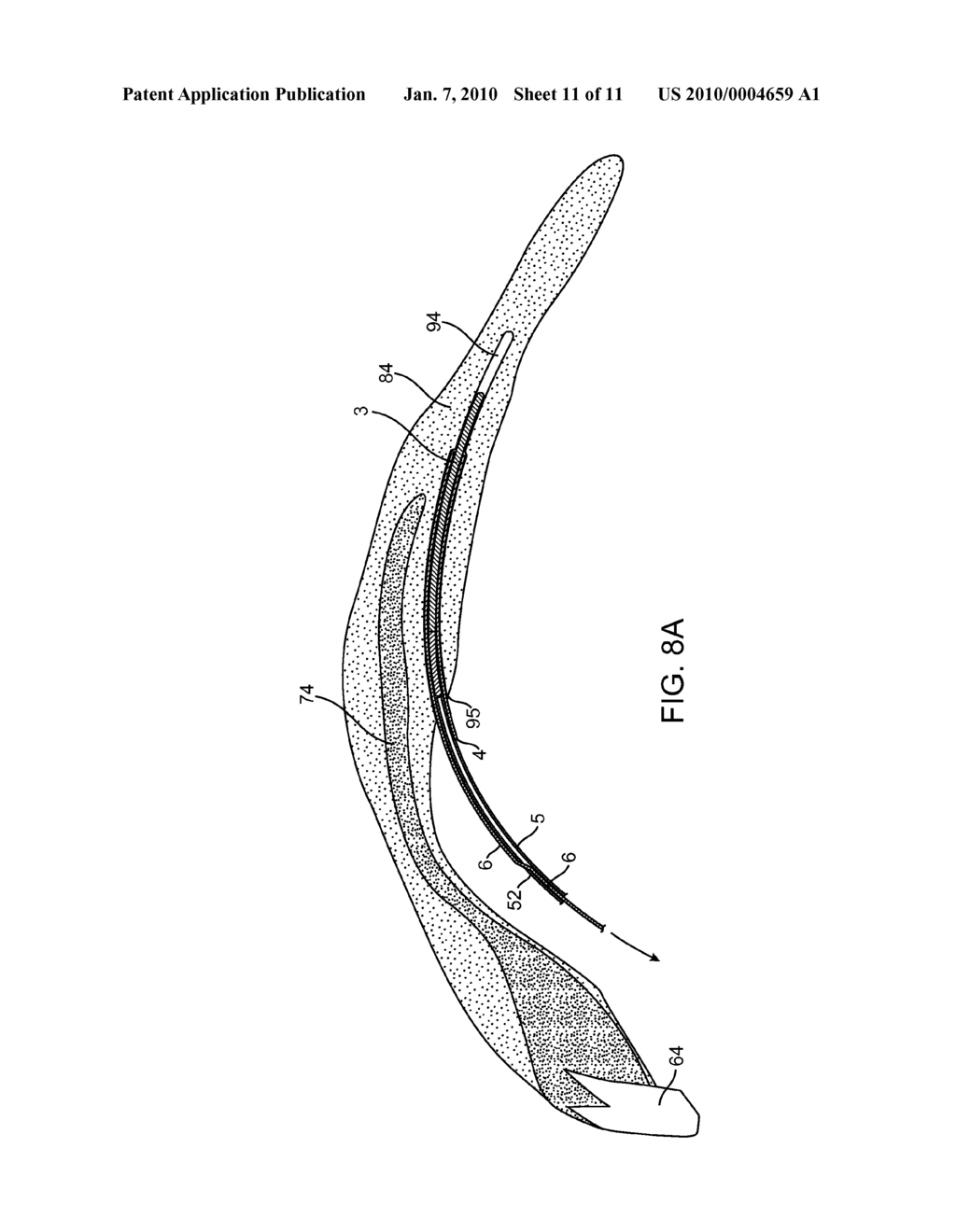 Cavitation Depth, Perforation Confirmation and Implant Delivery Tool - diagram, schematic, and image 12