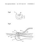 MEDICAL DEVICE FOR TISSUE ABLATION diagram and image