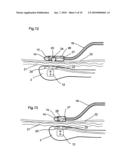 MEDICAL DEVICE FOR TISSUE ABLATION diagram and image