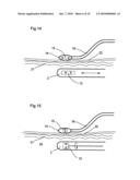 MEDICAL DEVICE FOR TISSUE ABLATION diagram and image