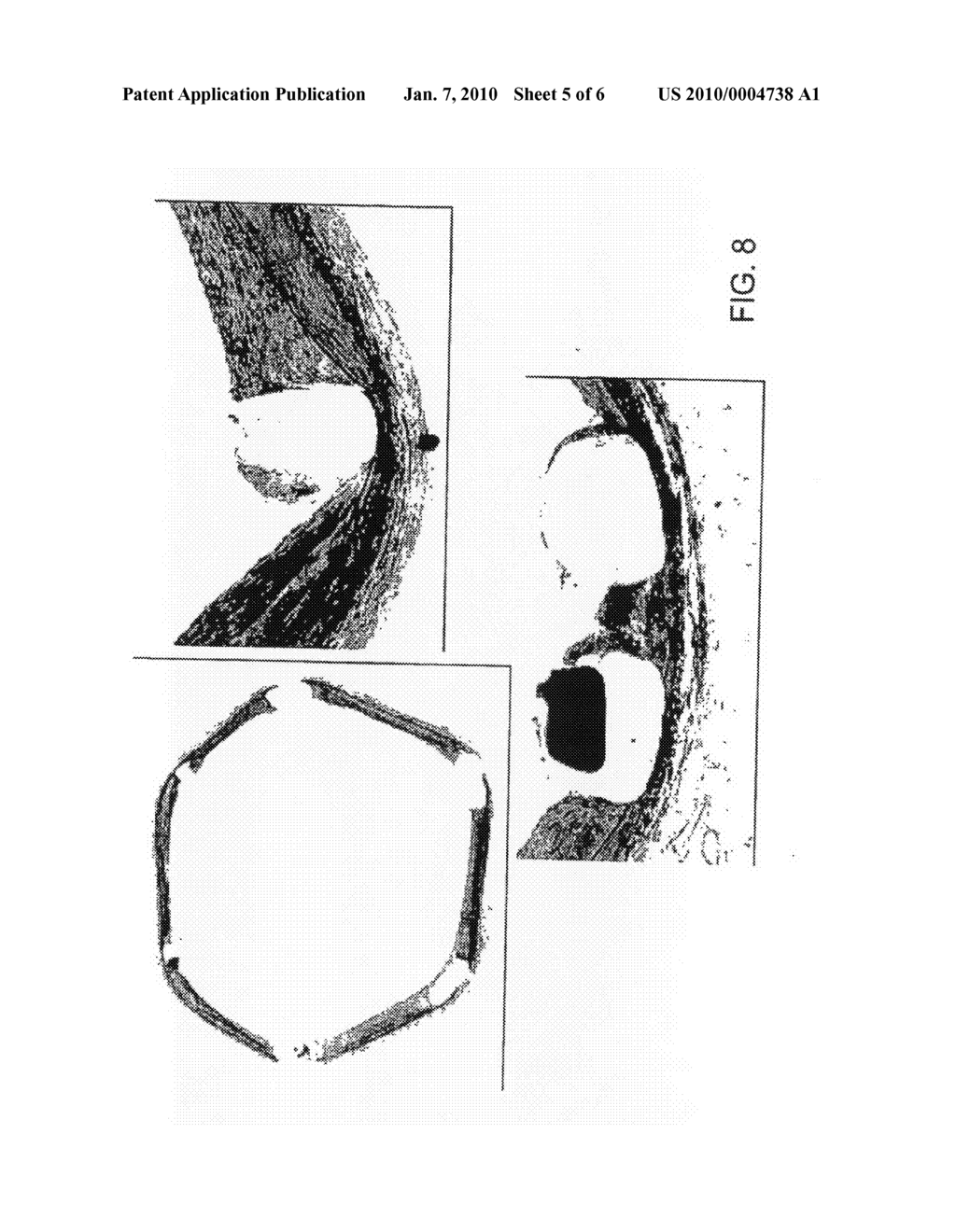 DRUG DELIVERY COATING FOR USE WITH A MEDICAL DEVICE AND METHODS OF TREATING VASCULAR INJURY - diagram, schematic, and image 06