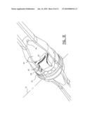 Hydrocyclone diagram and image