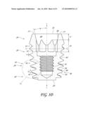 COMPACT DENTAL IMPLANT diagram and image