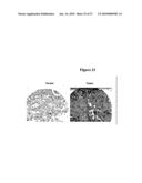 METHODS AND COMPOSITIONS FOR DIAGNOSING LUNG CANCER diagram and image