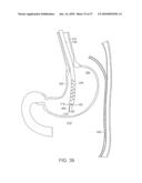 TEMPORARILY POSITIONABLE MEDICAL DEVICES diagram and image