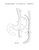 TEMPORARILY POSITIONABLE MEDICAL DEVICES diagram and image