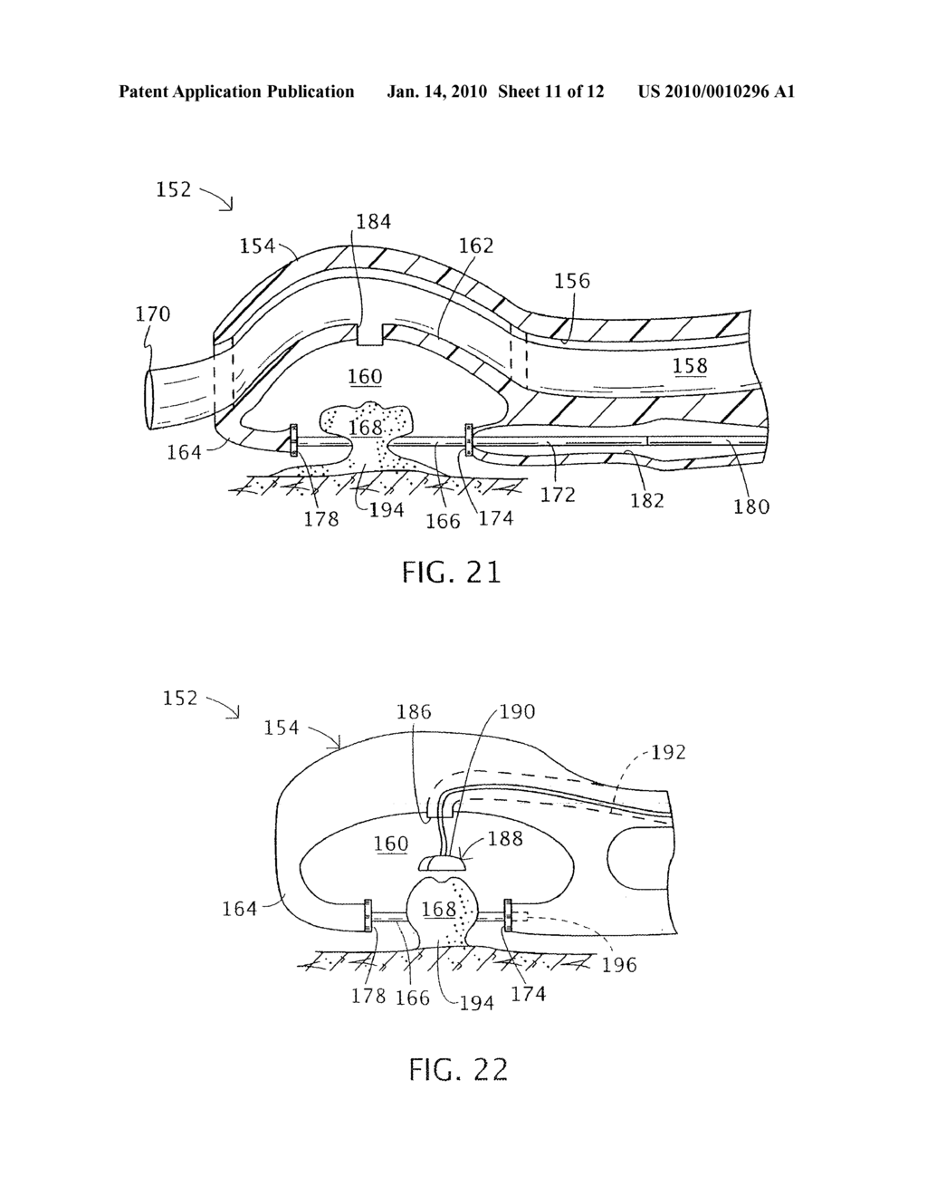 ENDOLUMINAL TREATMENT METHOD AND ASSOCIATED SURGICAL ASSEMBLY INCLUDING TISSUE OCCLUSION DEVICE - diagram, schematic, and image 12