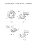 ENDOLUMINAL TREATMENT METHOD AND ASSOCIATED SURGICAL ASSEMBLY INCLUDING TISSUE OCCLUSION DEVICE diagram and image