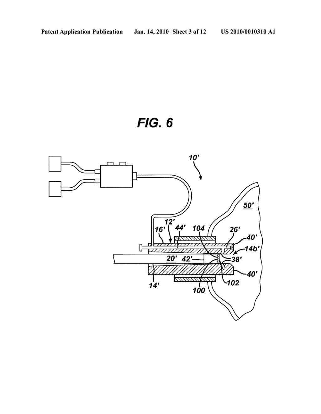 METHODS AND DEVICES FOR MAINTAINING VISIBILITY AND PROVIDING IRRIGATION AND/OR SUCTION DURING SURGICAL PROCEDURES - diagram, schematic, and image 04