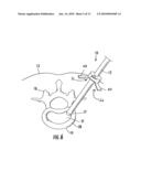 Cannula Stabilization Device, System, And Method Of Use diagram and image