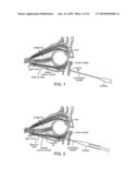 Retrobulbar Needle and Methods of Use diagram and image