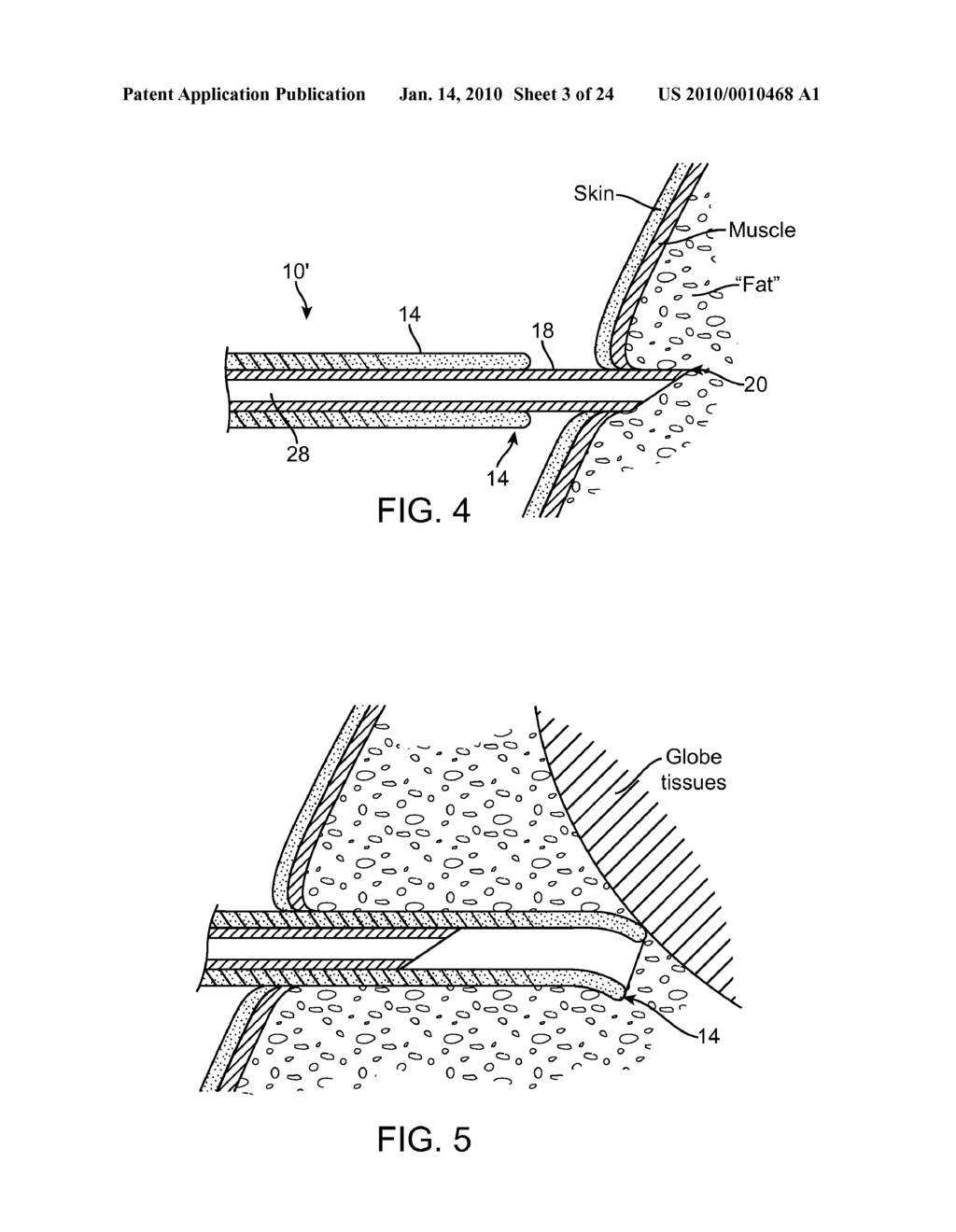 Retrobulbar Needle and Methods of Use - diagram, schematic, and image 04