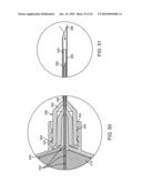 Retrobulbar Needle and Methods of Use diagram and image