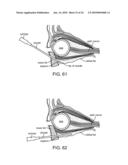 Retrobulbar Needle and Methods of Use diagram and image