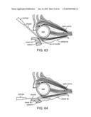 Retrobulbar Needle and Methods of Use diagram and image