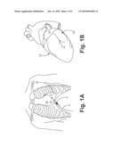 PRE-FORMED DELIVERY CATHETERS diagram and image