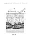 DEVICES AND METHODS FOR PERCUTANEOUS ENERGY DELIVERY diagram and image