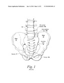 SACROILIAC JOINT FUSION ALIGNMENT GUIDE diagram and image