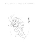 SACROILIAC JOINT FUSION ALIGNMENT GUIDE diagram and image