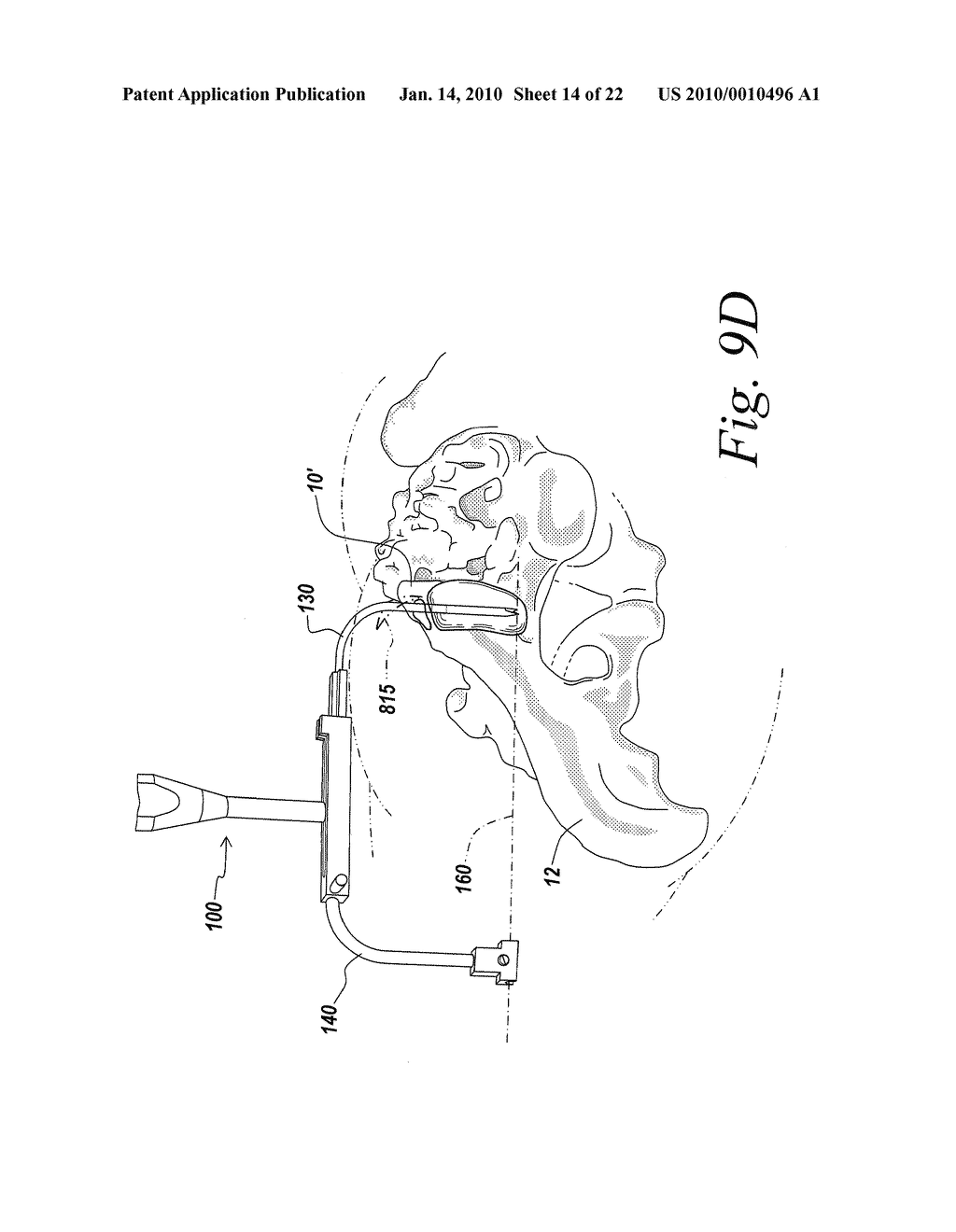 SACROILIAC JOINT FUSION ALIGNMENT GUIDE - diagram, schematic, and image 15