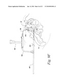 SACROILIAC JOINT FUSION ALIGNMENT GUIDE diagram and image