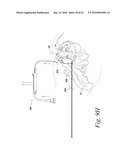 SACROILIAC JOINT FUSION ALIGNMENT GUIDE diagram and image