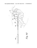 SACROILIAC JOINT FUSION ALIGNMENT GUIDE diagram and image