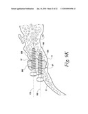 SACROILIAC JOINT FUSION ALIGNMENT GUIDE diagram and image