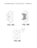 INSERTABLE PROSTHESIS AND PROSTHESIS BOARD FOR ANASTOMOSIS diagram and image