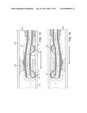 ROTATIONAL ATHERECTOMY DEVICE WITH FLUID INFLATABLE SUPPORT ELEMENTS AND TWO TORQUE TRANSMITTING COILS diagram and image