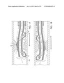 ROTATIONAL ATHERECTOMY DEVICE WITH FLUID INFLATABLE SUPPORT ELEMENTS AND TWO TORQUE TRANSMITTING COILS diagram and image