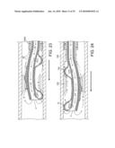 ROTATIONAL ATHERECTOMY DEVICE WITH FLUID INFLATABLE SUPPORT ELEMENTS AND TWO TORQUE TRANSMITTING COILS diagram and image