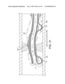 ROTATIONAL ATHERECTOMY DEVICE WITH FLUID INFLATABLE SUPPORT ELEMENTS AND TWO TORQUE TRANSMITTING COILS diagram and image