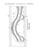 ROTATIONAL ATHERECTOMY DEVICE WITH FLUID INFLATABLE SUPPORT ELEMENTS AND TWO TORQUE TRANSMITTING COILS diagram and image