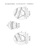 ROTATIONAL ATHERECTOMY DEVICE WITH FLUID INFLATABLE SUPPORT ELEMENTS AND TWO TORQUE TRANSMITTING COILS diagram and image