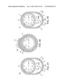 ROTATIONAL ATHERECTOMY DEVICE WITH FLUID INFLATABLE SUPPORT ELEMENTS AND TWO TORQUE TRANSMITTING COILS diagram and image