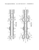 ROTATIONAL ATHERECTOMY DEVICE WITH FLUID INFLATABLE SUPPORT ELEMENTS AND TWO TORQUE TRANSMITTING COILS diagram and image