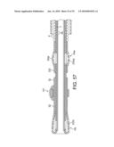 ROTATIONAL ATHERECTOMY DEVICE WITH FLUID INFLATABLE SUPPORT ELEMENTS AND TWO TORQUE TRANSMITTING COILS diagram and image