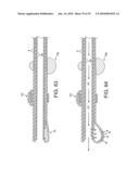 ROTATIONAL ATHERECTOMY DEVICE WITH FLUID INFLATABLE SUPPORT ELEMENTS AND TWO TORQUE TRANSMITTING COILS diagram and image