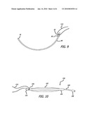 Balloon Dilation for Implantable Prosthesis diagram and image