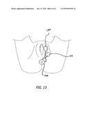 Balloon Dilation for Implantable Prosthesis diagram and image