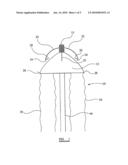 Device For Use In Treatment of Vericose Veins diagram and image