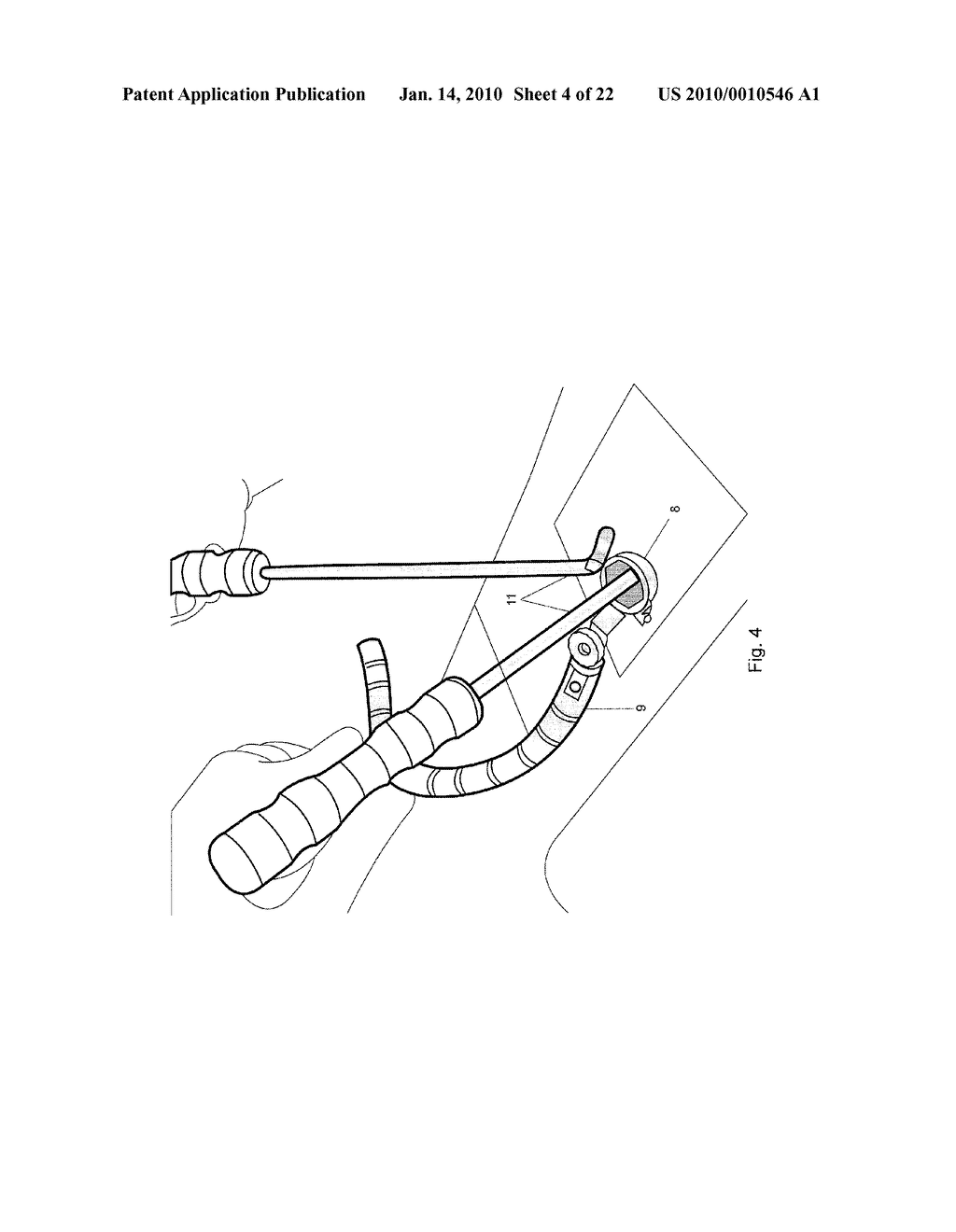 Minimally Invasive Instruments and Methods for the Micro Endoscopic Application of Spine Stabilizers in the Interspinous Space - diagram, schematic, and image 05