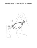 Minimally Invasive Instruments and Methods for the Micro Endoscopic Application of Spine Stabilizers in the Interspinous Space diagram and image